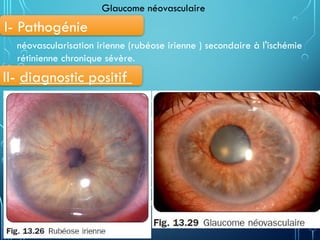 • douleur et baisse visuelle sévère
• Rubéose irienne et présence de néovaisseaux dans angle iridocornéen
• Hypertonie oculaire
• OEdème cornéen, mydriase et rubéose sévère
Remarque: rechercher d’autres complications ( hémorragie
intravitréenne, et décollement de la rétine tractionnel)
Glaucome néovasculaire
II- diagnostic positif
I- Pathogénie
néovascularisation irienne (rubéose irienne ) secondaire à l'ischémie
rétinienne chronique sévère.
 