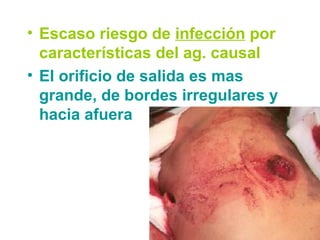 • Escaso riesgo de infección por
características del ag. causal
• El orificio de salida es mas
grande, de bordes irregulares y
hacia afuera
 