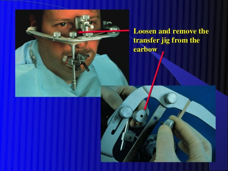 11. max mand rel facebow