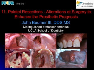 11. Palatal Resections - Alterations at Surgery to
       Enhance the Prosthetic Prognosis
            John Beumer III, DDS,MS
            Distinguished professor emeritus
                UCLA School of Dentistry
 