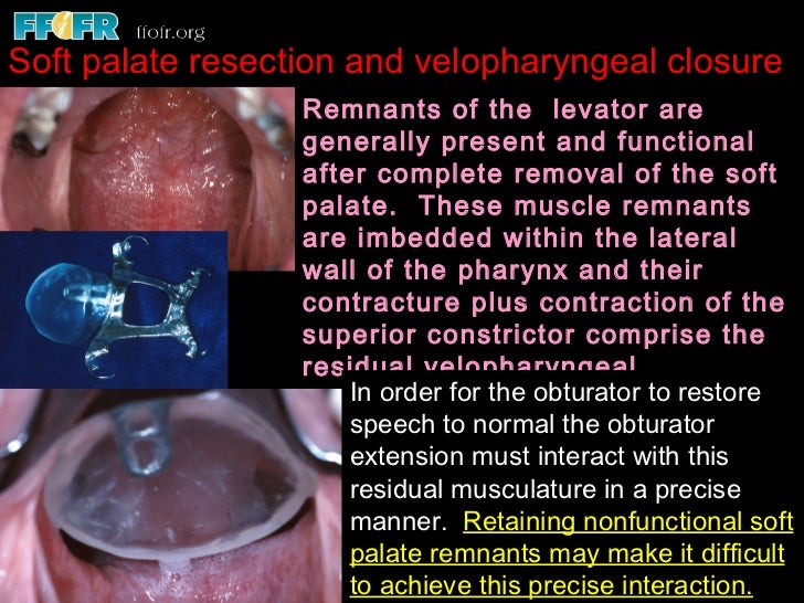 11. palatal resections alterations at surgery to enhance the prosthet…