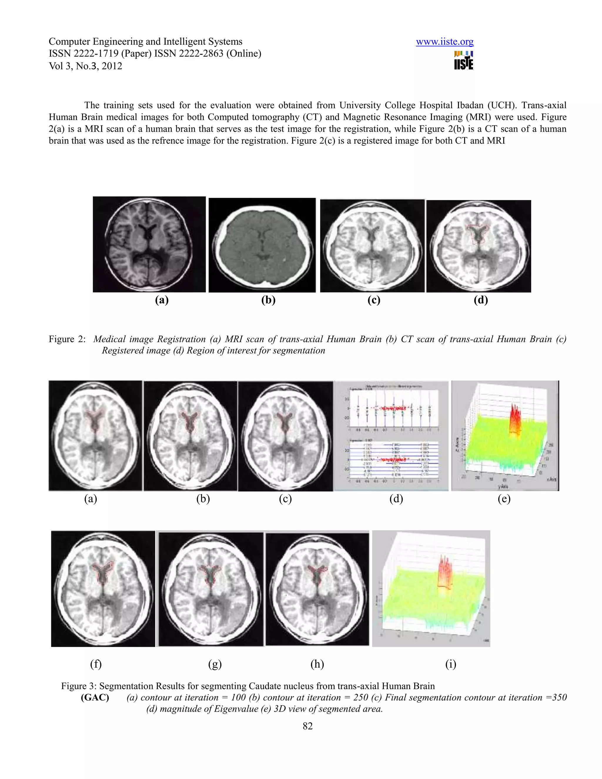 Computer Engineering and Intelligent Systems                                               www.iiste.org
ISSN 2222-1719 (Paper) ISSN 2222-2863 (Online)
Vol 3, No.3, 2012


          The training sets used for the evaluation were obtained from University College Hospital Ibadan (UCH). Trans-axial
Human Brain medical images for both Computed tomography (CT) and Magnetic Resonance Imaging (MRI) were used. Figure
2(a) is a MRI scan of a human brain that serves as the test image for the registration, while Figure 2(b) is a CT scan of a human
brain that was used as the refrence image for the registration. Figure 2(c) is a registered image for both CT and MRI




                          (a)                       (b)                        (c)                         (d)


Figure 2: Medical image Registration (a) MRI scan of trans-axial Human Brain (b) CT scan of trans-axial Human Brain (c)
           Registered image (d) Region of interest for segmentation




        (a)                         (b)                   (c)                        (d)                         (e)




          (f)                          (g)                       (h)                              (i)
   Figure 3: Segmentation Results for segmenting Caudate nucleus from trans-axial Human Brain
        (GAC)     (a) contour at iteration = 100 (b) contour at iteration = 250 (c) Final segmentation contour at iteration =350
                        (d) magnitude of Eigenvalue (e) 3D view of segmented area.
                                                                82
 