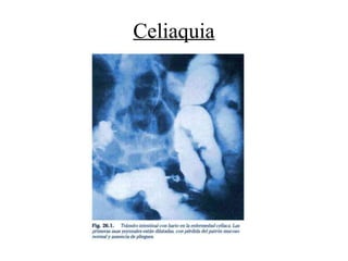 Celiaquia
 