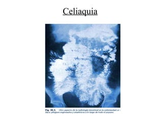 Celiaquia
 