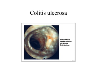 Colitis ulcerosa
 