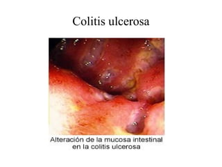 Colitis ulcerosa
 