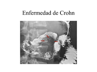 Enfermedad de Crohn
 