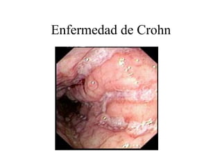 Enfermedad de Crohn
 