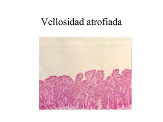 Vellosidad atrofiada
 