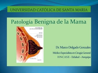 UNIVERSIDAD CATÓLICA DE SANTA MARIA Patología Benigna de la Mama Dr. Marco Delgado Gonzales         Médico Especialista en Cirugía General H N C A S E -  EsSalud – Arequipa    