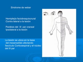 Síndrome de weber
Hemiplejía faciobraquiocrural
Contra lateral a la lesión
Parálisis del III par craneal
Ipsolateral a la lesión
La lesión se ubica en la base
del mesensefalo afectando
fascículo Corticoespinal y el núcleo
del III par
 