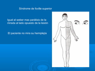 Síndrome de foville superior
Igual al weber mas parálisis de la
mirada al lado opuesto de la lesión
El paciente no mira su hemiplejía
 