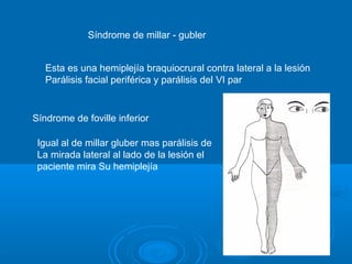 Síndrome de millar - gubler
Esta es una hemiplejía braquiocrural contra lateral a la lesión
Parálisis facial periférica y parálisis del VI par
Síndrome de foville inferior
Igual al de millar gluber mas parálisis de
La mirada lateral al lado de la lesión el
paciente mira Su hemiplejía
 