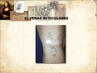 C) VENAS RETICULARES 
