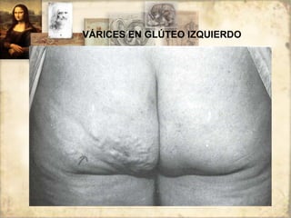 VÁRICES EN GLÚTEO IZQUIERDO 