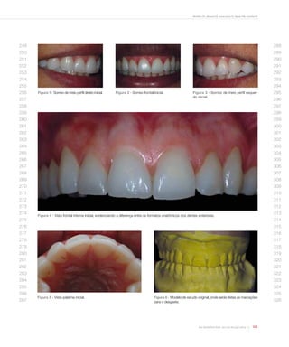Bertoldo CES, Miranda DA, Souza-Junior EJ, Aguiar FHB, Lovadino JR

249

288

250

289

251

290

252

291

253

292

254

293
294

255
256

Figura 1 - Sorriso de meio perfil direito inicial.

257

Figura 2 - Sorriso frontal inicial.

Figura 3 - Sorriso de meio perfil esquerdo inicial.

295
296

258

297

259

298

260

299

261

300

262

301

263

302

264

303

265

304

266

305

267

306

268

307

269

308

270

309

271

310

272

311

273

312

274
275

313

Figura 4 - Vista frontal interna inicial, evidenciando a diferença entre os formatos anatômicos dos dentes anteriores.

314

276

315

277

316

278

317

279

318

280

319

281

320

282

321

283

322

284

323

285

324

286
287

Figura 5 - Vista palatina inicial.

Figura 6 - Modelo de estudo original, onde serão feitas as marcações
para o desgaste.

Rev Dental Press Estét. 2012 out-dez;9(4):118-25

121

325
326

 