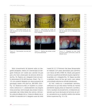 Contorno cosmético - estética sem restauração

327

366

328

367

329

368

330

369

331

370

332

371
372

333
334
335

Figura 7 - Vista lateral direita do modelo de estudo com as marcações dos
desgastes.

Figura 8 - Vista frontal do modelo de
estudo com as marcações das áreas de
futuro desgaste.

Figura 9 - Vista lateral esquerda do modelo de estudo com as marcações dos
desgastes.

373
374

336

375

337

376

338

377

339

378

340

379

341

380

342

381

343

382

344
345

Figura 10 - Demarcações intra-orais dos
desgastes.

Figura 11 - Abertura das ameias incisais
com ponta diamantada.

346

Figura 12 - Desgaste da crista mesial
do incisivo lateral, diminuindo a área de
reflexão de luz.

383
384
385

347

386

348

387

349

388

350

389

351

390

352

Após consentimento da paciente sobre os des-

mesial do 2.2. O Polimento das áreas abrasionadas

391

353

gastes planejados, realizou-se a demarcação do des-

foi realizado com pasta diamantada para polimento

392

354

gaste intrabucal com caneta azul, servindo de guia

com discos de feltro (FGM, SC, Brasil), para garantir

393

355

para uma maior preservação da estrutura dental sa-

uma lisura superficial semelhante àquela originalmen-

394

356

dia (Fig. 10). Realizou-se o desgaste inicial com pon-

te perdida com o desgaste (Fig. 14). Seguiu-se então

395

357

ta diamantada #2135 (KG Sorensen, Brasil – Fig. 11,

a aplicação tópica de flúor gel neutro, para realizar

396

358

12), com posterior desgaste com discos abrasivos de

uma proteção adicional ao esmalte abrasionado.

397

359

granulação média e fina (Sof-Lex, 3M ESPE, EUA –

Ao final, avaliou-se a sensibilidade dentinária,

398

360

Fig. 13). Observa-se então um equilíbrio no compri-

verificando-se que esta estava mantida de maneira

399

361

mento vertical do 2.1, arredondamento dos ângulos

semelhante àquela prévia ao tratamento cosmético.

400

362

inciso-proximais, harmonização das ameias incisais e

Como resultado do procedimento, é nitidamente ob-

401

363

suavização das cristas distais dos caninos, diminuin-

servado que houve devolução da harmonia do sorri-

402

364

do a área de reflexão de luz. A área de reflexão de luz

so, percebendo-se um equilíbrio estético dos dentes

403

365

também foi reduzida com o desgaste suave da crista

ântero-superiores (Fig. 15 a 19).

404

122

Rev Dental Press Estét. 2012 out-dez;9(4):118-25

 