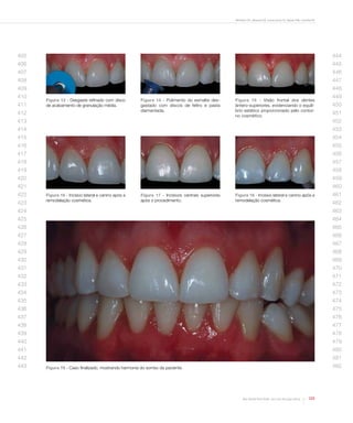 Bertoldo CES, Miranda DA, Souza-Junior EJ, Aguiar FHB, Lovadino JR

405

444

406

445

407

446

408

447

409

448

410
411

Figura 13 - Desgaste refinado com disco
de acabamento de granulação média.

412

Figura 14 - Polimento do esmalte desgastado com discos de feltro e pasta
diamantada.

413

Figura 15 - Visão frontal dos dentes
ântero-superiores, evidenciando o equilíbrio estético proporcionado pelo contorno cosmético.

449
450
451
452

414

453

415

454

416

455

417

456

418

457

419

458

420

459

421

460

422
423

Figura 16 - Incisivo lateral e canino após a
remodelação cosmética.

Figura 17 - Incisivos centrais superiores
após o procedimento.

Figura 18 - Incisivo lateral e canino após a
remodelação cosmética.

461
462

424

463

425

464

426

465

427

466

428

467

429

468

430

469

431

470

432

471

433

472

434

473

435

474

436

475

437

476

438

477

439

478

440

479

441

480

442

481

443

482

Figura 19 - Caso finalizado, mostrando harmonia do sorriso da paciente.

Rev Dental Press Estét. 2012 out-dez;9(4):118-25

123

 