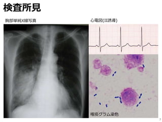 検査所見
7
胸部単純X線写真 心電図(II誘導)
喀痰グラム染色
 