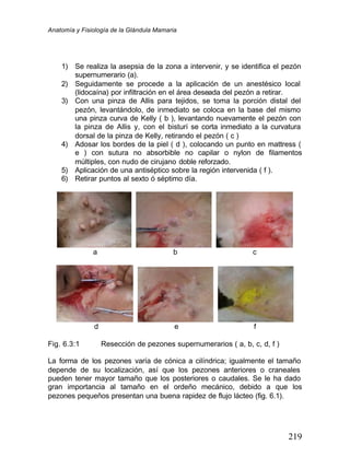 Anatomía y Fisiología de la Glándula Mamaria
219
1) Se realiza la asepsia de la zona a intervenir, y se identifica el pezón
supernumerario (a).
2) Seguidamente se procede a la aplicación de un anestésico local
(lidocaína) por infiltración en el área deseada del pezón a retirar.
3) Con una pinza de Allis para tejidos, se toma la porción distal del
pezón, levantándolo, de inmediato se coloca en la base del mismo
una pinza curva de Kelly ( b ), levantando nuevamente el pezón con
la pinza de Allis y, con el bisturí se corta inmediato a la curvatura
dorsal de la pinza de Kelly, retirando el pezón ( c )
4) Adosar los bordes de la piel ( d ), colocando un punto en mattress (
e ) con sutura no absorbible no capilar o nylon de filamentos
múltiples, con nudo de cirujano doble reforzado.
5) Aplicación de una antiséptico sobre la región intervenida ( f ).
6) Retirar puntos al sexto ó séptimo día.
a b c
d e f
Fig. 6.3:1 Resección de pezones supernumerarios ( a, b, c, d, f )
La forma de los pezones varía de cónica a cilíndrica; igualmente el tamaño
depende de su localización, así que los pezones anteriores o craneales
pueden tener mayor tamaño que los posteriores o caudales. Se le ha dado
gran importancia al tamaño en el ordeño mecánico, debido a que los
pezones pequeños presentan una buena rapidez de flujo lácteo (fig. 6.1).
 
