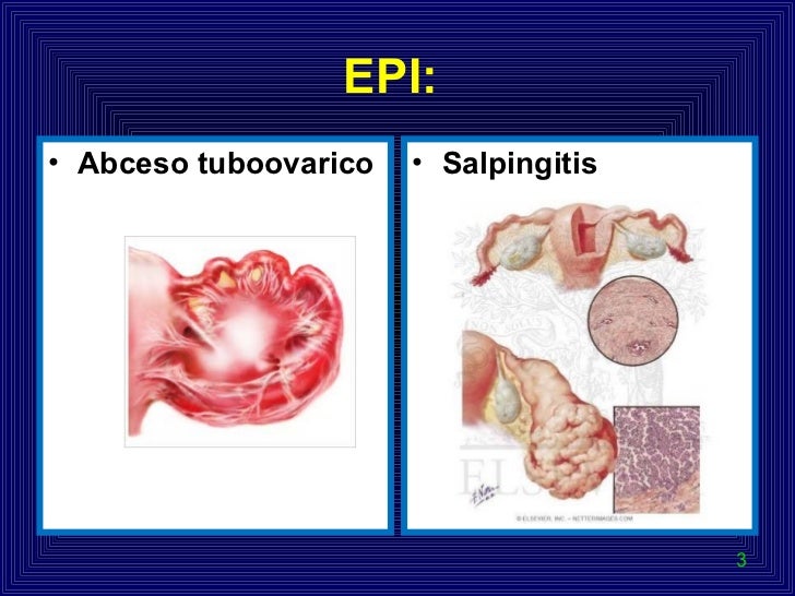 Enfermedad inflamatoria pélvica - CICAT-SALUD