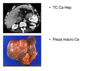 • TC Ca Hep




• Pieza macro Ca
 