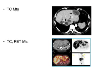 • TC Mts




• TC, PET Mts
 