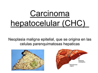 Carcinoma
 hepatocelular (CHC)
Neoplasia maligna epitelial, que se origina en las
      celulas parenquimatosas hepaticas
 
