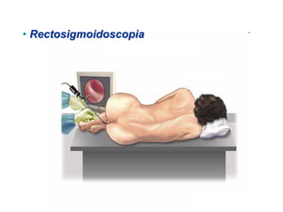• Rectosigmoidoscopia
 