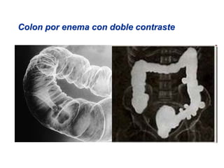 Colon por enema con doble contraste
 
