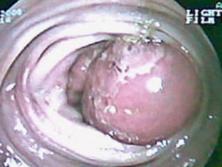 cancer de colon
