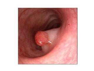cancer de colon
