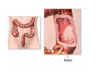 cancer de colon