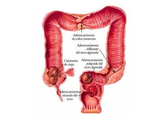 cancer de colon