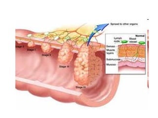 cancer de colon