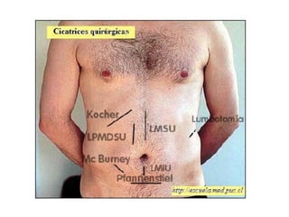 cancer de colon