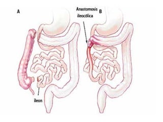 cancer de colon