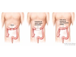 cancer de colon
