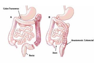 cancer de colon
