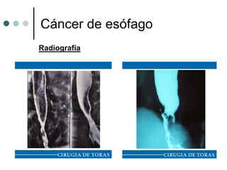 Cáncer de esófago
Radiografía
 