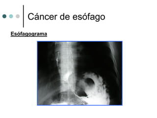 Cáncer de esófago
Esófagograma
 