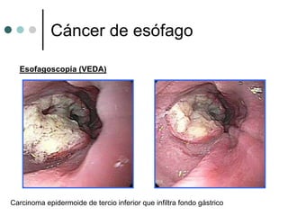 Cáncer de esófago

  Esofagoscopía (VEDA)




Carcinoma epidermoide de tercio inferior que infiltra fondo gástrico
 