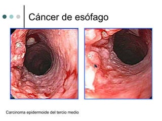 Cáncer de esófago




Carcinoma epidermoide del tercio medio
 