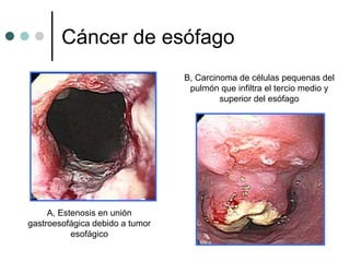 Cáncer de esófago
                                 B, Carcinoma de células pequenas del
                                  pulmón que infiltra el tercio medio y
                                          superior del esófago




     A, Estenosis en unión
gastroesofágica debido a tumor
           esofágico
 