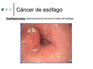 Cáncer de esófago
Esofagoscopía: Adenocarcinoma del tercio medio del esófago
 