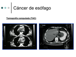 Cáncer de esófago

Tomografía computada (TAC)
 