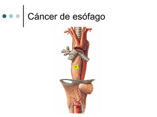Cáncer de esófago




          R
 