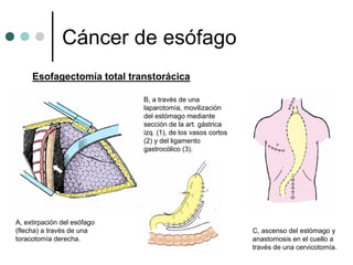 Cáncer de esófago
     Esofagectomía total transtorácica

                             B, a través de una
                             laparotomía, movilización
                             del estómago mediante
                             sección de la art. gástrica
                             izq. (1), de los vasos cortos
                             (2) y del ligamento
                             gastrocólico (3).




A, extirpación del esófago
(flecha) a través de una                                     C, ascenso del estómago y
toracotomía derecha.                                         anastomosis en el cuello a
                                                             través de una cervicotomía.
 