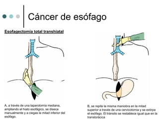 Cáncer de esófago
Esofagectomía total transhiatal




A, a través de una laparotomía mediana,        B, se repite la misma maniobra en la mitad
ampliando el hiato esofágico, se diseca        superior a través de una cervicotomia y se extirpa
manualmente y a ciegas la mitad inferior del   el esófago. El tránsito se restablece igual que en la
esófago.                                       transtorácica
 
