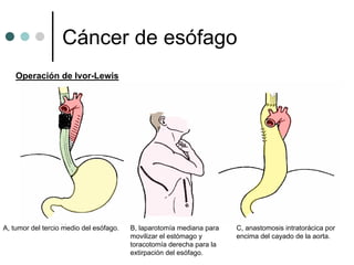 Cáncer de esófago
    Operación de Ivor-Lewis




A, tumor del tercio medio del esófago.   B, laparotomía mediana para   C, anastomosis intratorácica por
                                         movilizar el estómago y       encima del cayado de la aorta.
                                         toracotomía derecha para la
                                         extirpación del esófago.
 